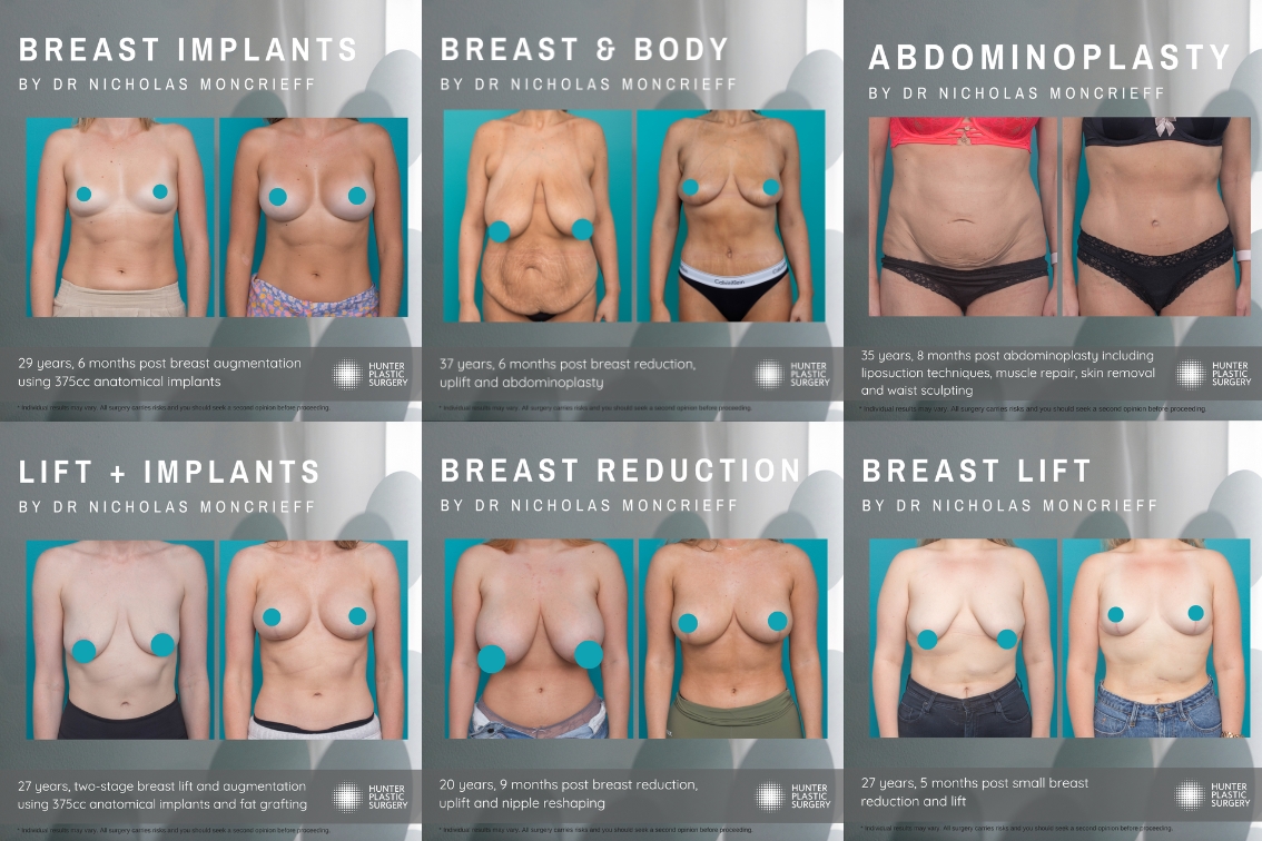 How much does a breast augmentation in Newcastle cost