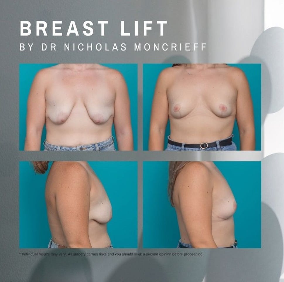 23 years - 7 months post surgery