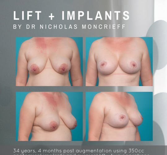 34 years - 4 months post surgery