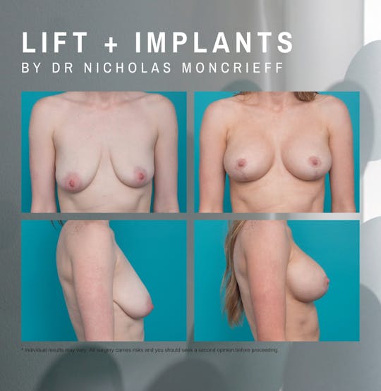 27 years - 7 months post surgery