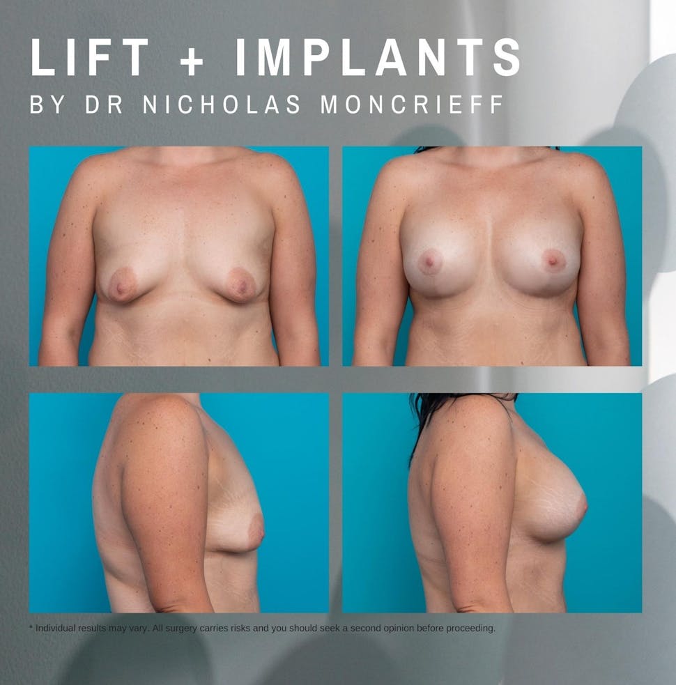 36 years - 8 months post surgery