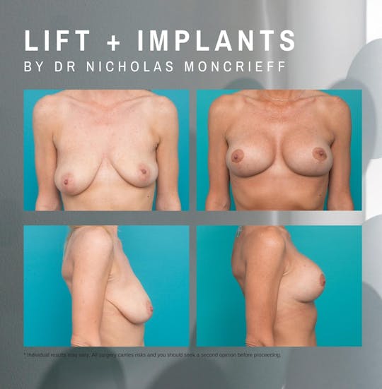 41 years - 6 months post surgery