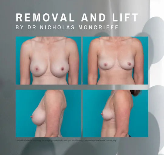 39 years - 8 months post surgery