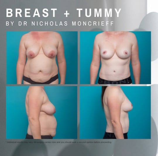 36-years-21-months-post-surgery