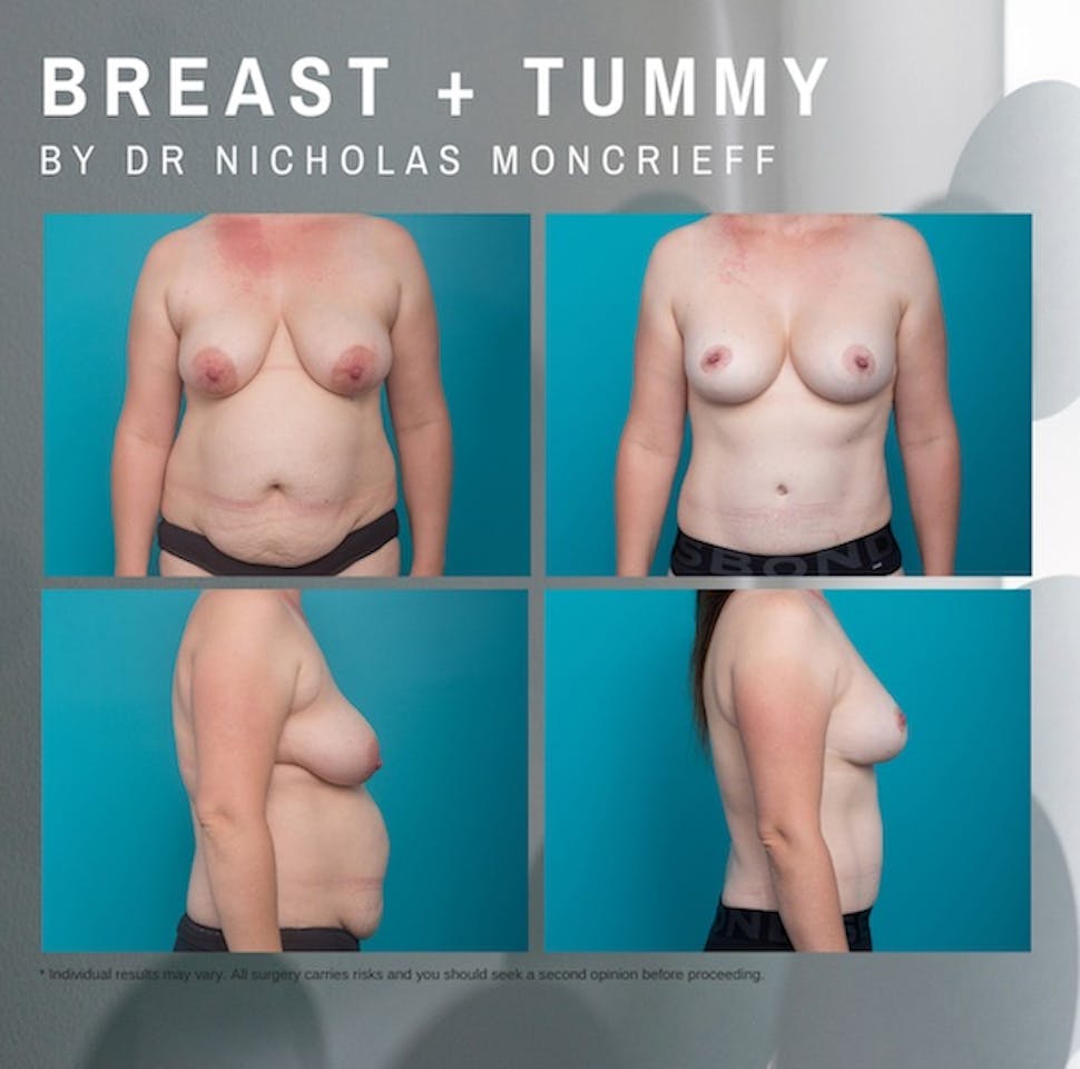 36-years-21-months-post-surgery