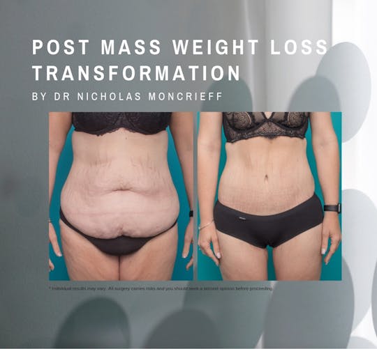 35 years - 24 months post surgery