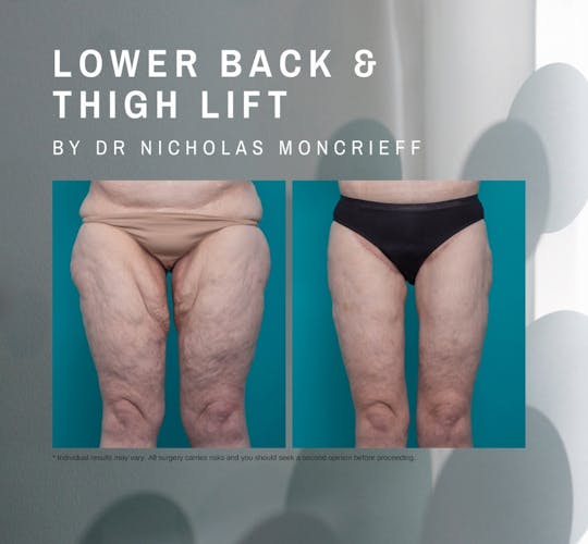 42 years - 7 months post surgery