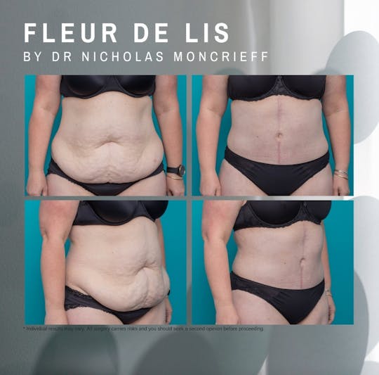 44 years - 8 months post surgery