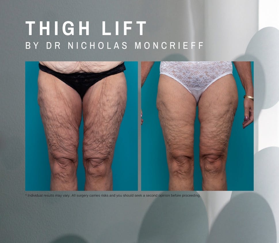 56 years old - 6 months post surgery