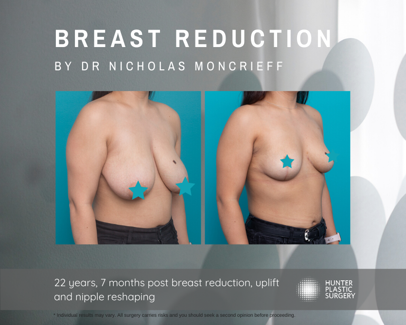 Gallery PatientJourneys Magical-Winter Jasmine jas-pt-journey-before-and-after-breast-reduction-and-lift-before-and-after-by-dr-nicholas-moncrieff-at-hunter-plastic-surgery-22-yr-old-patient-7-months-post-surgery-1
