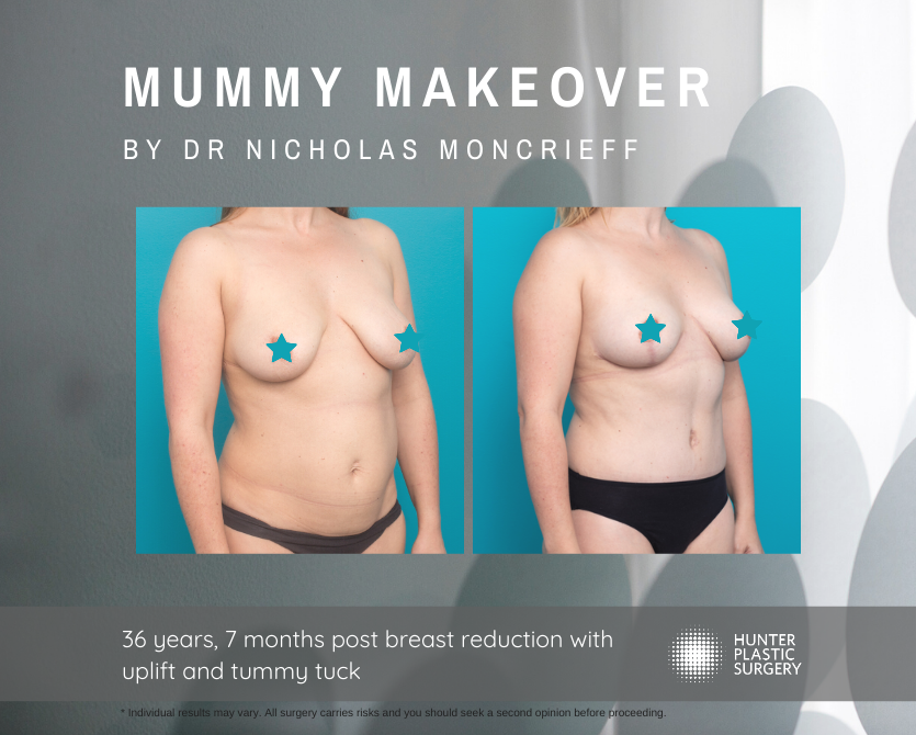 Gallery PatientJourneys Magical-Winter Lisa lisa-pt-journey-ba-breast-reduction-and-tummy-tuck-mummy-makeover-before-and-after-by-dr-nicholas-moncrieff-at-hunter-plastic-surgery-36-yr-old-patient-7-months-post-surgery-1