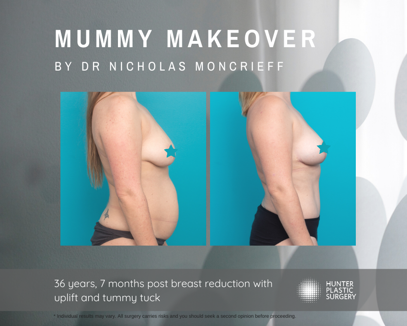 Gallery PatientJourneys Magical-Winter Lisa lisa-pt-journey-ba-breast-reduction-and-tummy-tuck-mummy-makeover-before-and-after-by-dr-nicholas-moncrieff-at-hunter-plastic-surgery-36-yr-old-patient-7-months-post-surgery-2