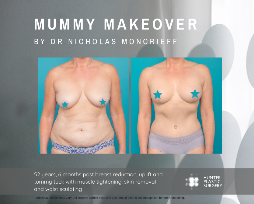 Gallery PatientJourneys Moncrieff-Magic-Summer-2019 Jenni Pt-journey-Breast reduction and tummy tuck - mummy makeover - before and after by Dr Nicholas Moncrieff at Hunter Plastic Surgery - 52 yr old patient 6 months post surgery