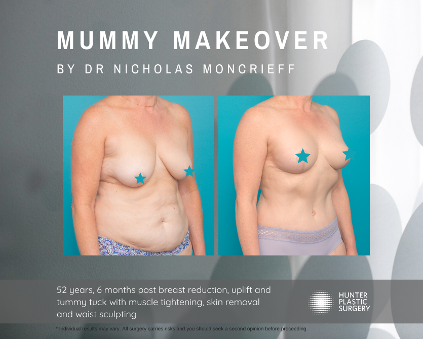 Gallery PatientJourneys Moncrieff-Magic-Summer-2019 Jenni pt-journey-breast-reduction-and-tummy-tuck-mummy-makeover-before-and-after-by-dr-nicholas-moncrieff-at-hunter-plastic-surgery-52-yr-old-patient-6-months-post-surgery-1