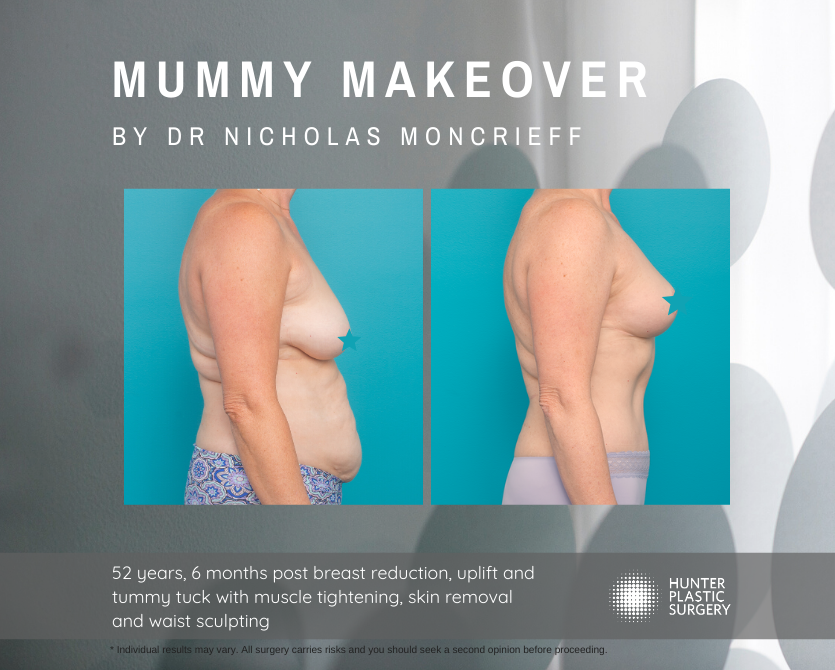 Gallery PatientJourneys Moncrieff-Magic-Summer-2019 Jenni pt-journey-breast-reduction-and-tummy-tuck-mummy-makeover-before-and-after-by-dr-nicholas-moncrieff-at-hunter-plastic-surgery-52-yr-old-patient-6-months-post-surgery-2