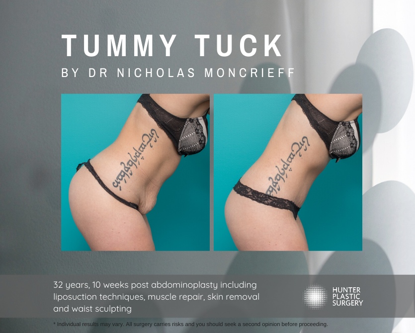 Gallery PatientJourneys Moncrieff-Magic-Summer-2019 Kristen pt-journey-32-year-old-tummy-tuck-patient-10-weeks-post-by-dr-nicholas-moncrieff-hunter-plastic-surgery-1