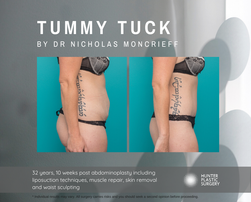 Gallery PatientJourneys Moncrieff-Magic-Summer-2019 Kristen pt-journey-32-year-old-tummy-tuck-patient-10-weeks-post-by-dr-nicholas-moncrieff-hunter-plastic-surgery-2
