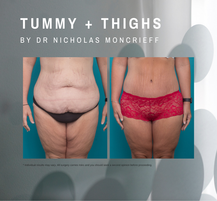 abdominoplasty and thigh lift newcastle