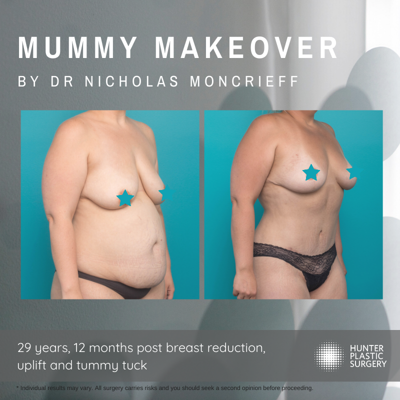 Gallery PatientJourneys breast-reduction-and-tummy-tuck-mummy-makeover-before-and-after-by-dr-nicholas-moncrieff-at-hunter-plastic-surgery-29-yr-old-patient-6-months-post-surgery-555cc-anatomical-implants-1