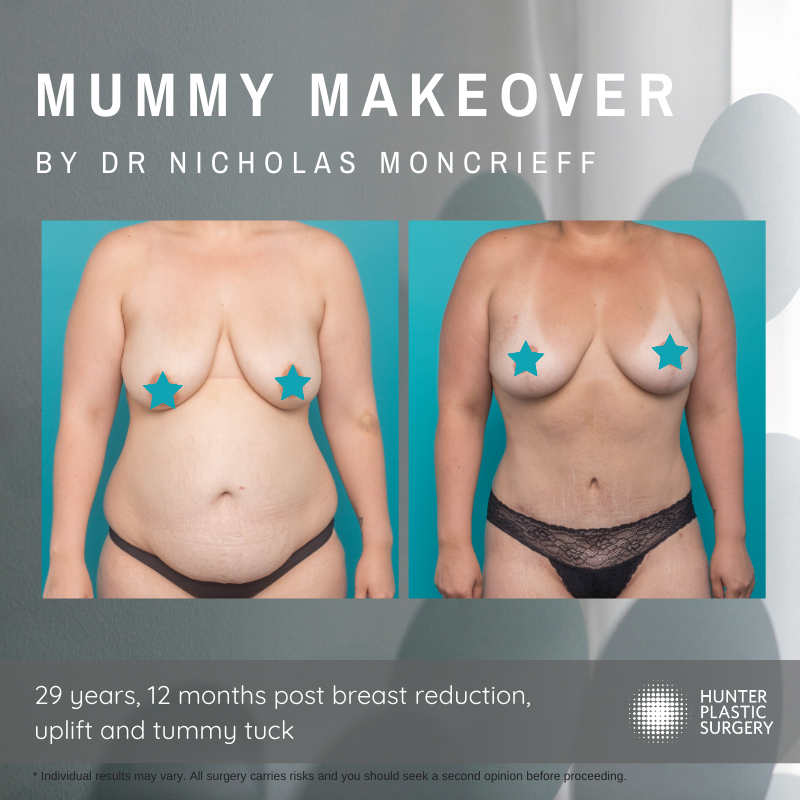 Gallery PatientJourneys breast-reduction-and-tummy-tuck-mummy-makeover-before-and-after-by-dr-nicholas-moncrieff-at-hunter-plastic-surgery-29-yr-old-patient-6-months-post-surgery-555cc-anatomical-implants-2