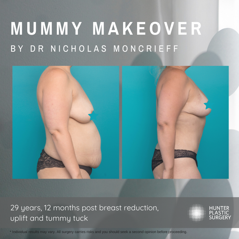 Gallery PatientJourneys breast-reduction-and-tummy-tuck-mummy-makeover-before-and-after-by-dr-nicholas-moncrieff-at-hunter-plastic-surgery-29-yr-old-patient-6-months-post-surgery-555cc-anatomical-implants-3