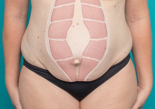 How can I tell if I have muscle separation post-pregnancy?