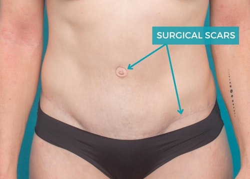 What does a tummy tuck scar look like?