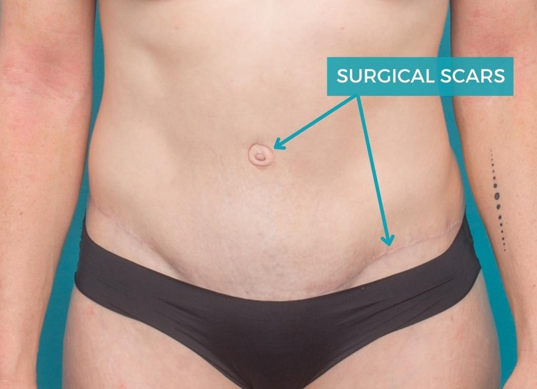 What does a tummy tuck scar look like