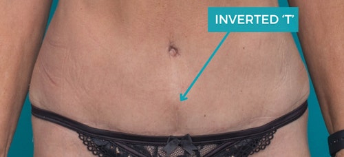 Will I need an inverted T scar with my abdominoplasty?