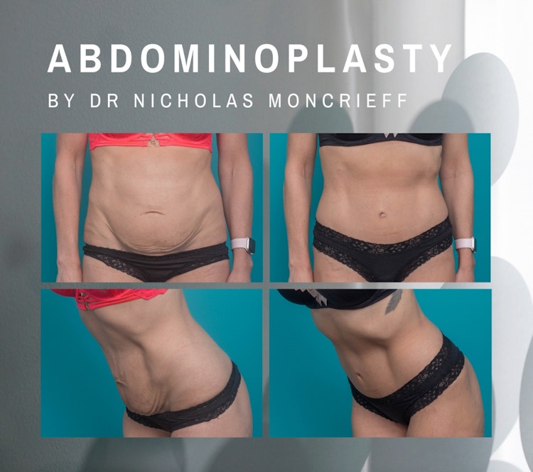 Tummy Tuck results by Dr Nicholas Moncrieff Newcastle
