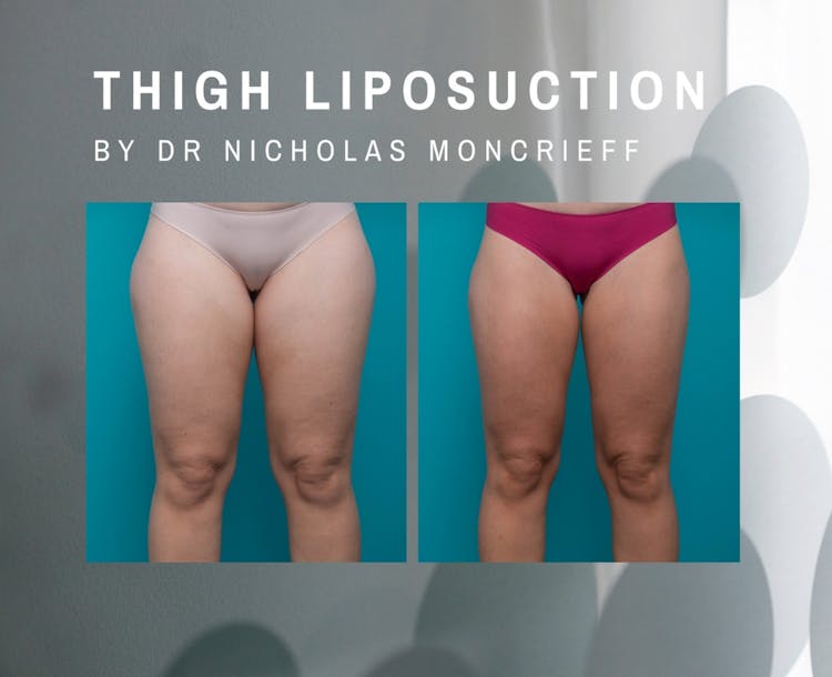 Procedures Body cropped-images 30-years-old-4-months-post-liposuction-to-bilateral-thighs-by-Dr-Nicholas-Moncrieff-Hunter-Plastic-Surgery-0-0-1079-878-1697671282