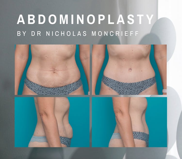 abdominoplasty by Dr Nicholas Moncrieff