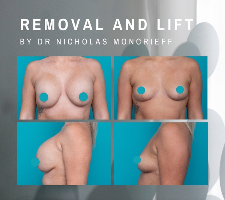 Breast Implant removal and uplift before and after