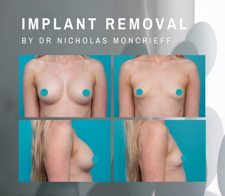 Breast Implant removal 