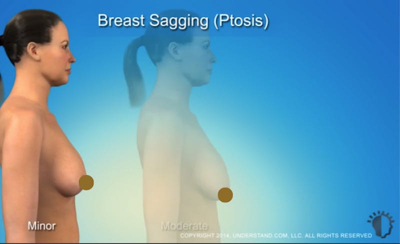 Procedures Breast BreastLift breast-lift-video