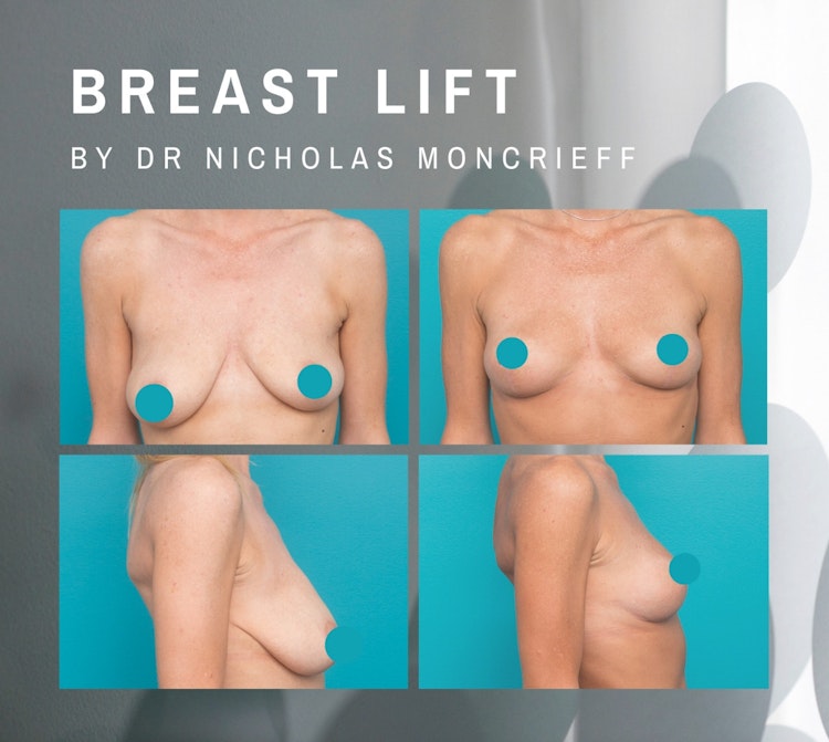 breast lift by Dr Nicholas Moncrieff