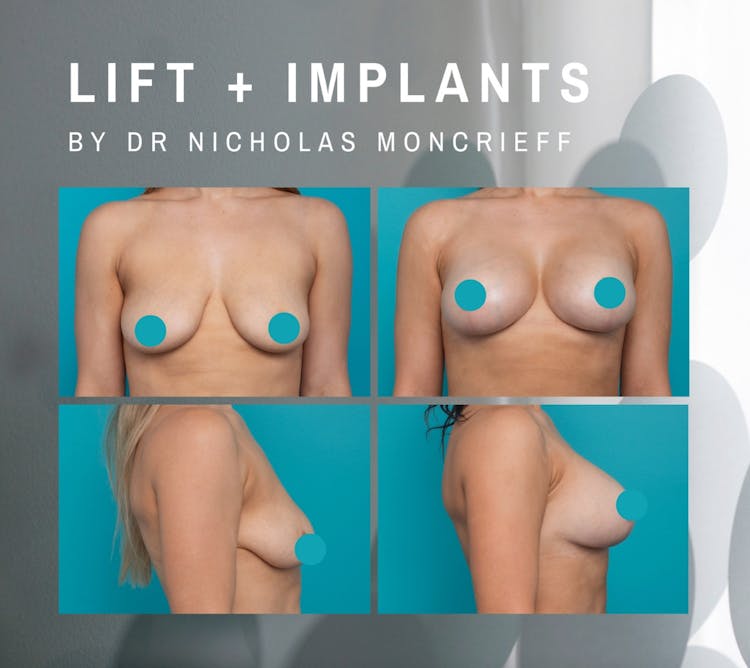 Breast Lift with Implants Dr Moncrieff results