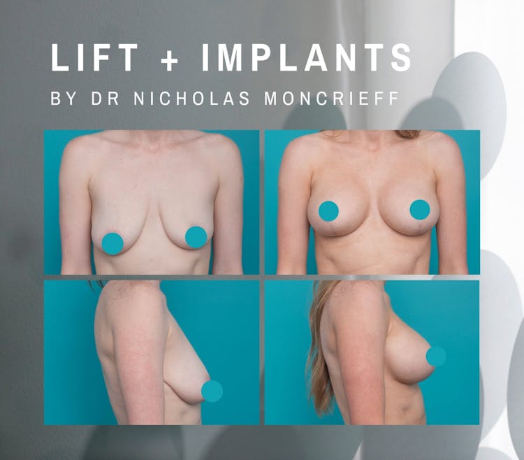 Breast Lift with Implants Dr Moncrieff results