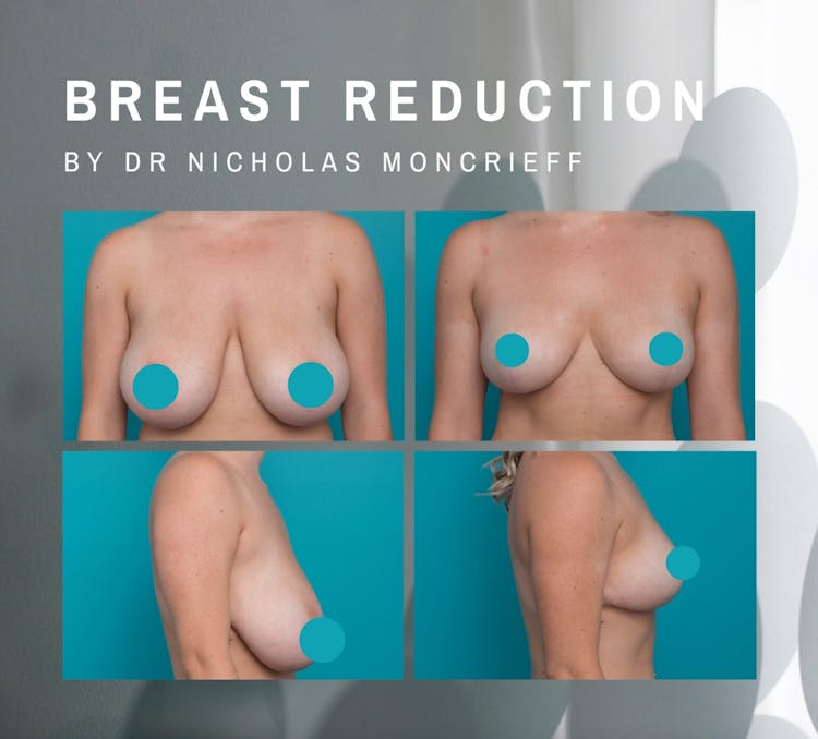 Breast reduction and nipple reshape