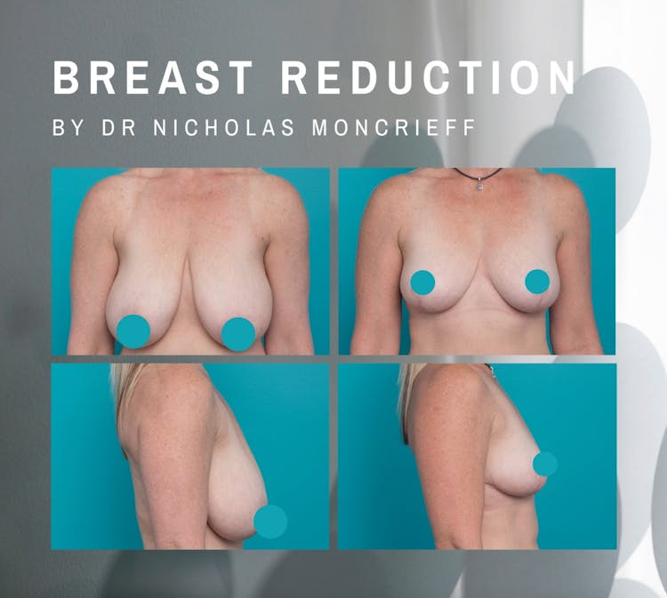 Breast reduction and nipple reshape