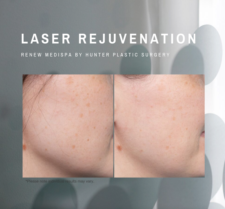 RenewMedispa Clear_Glow_facials Laser-clear-treatment-to-pigment-on-face-Hunter-Plastic-Surgery-33-yr-old-patient-2-months-post