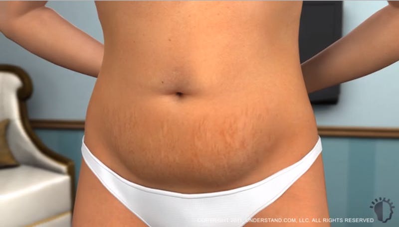 Video VideoThumbnails tummytuck