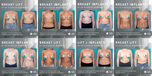 What are tuberous breasts?